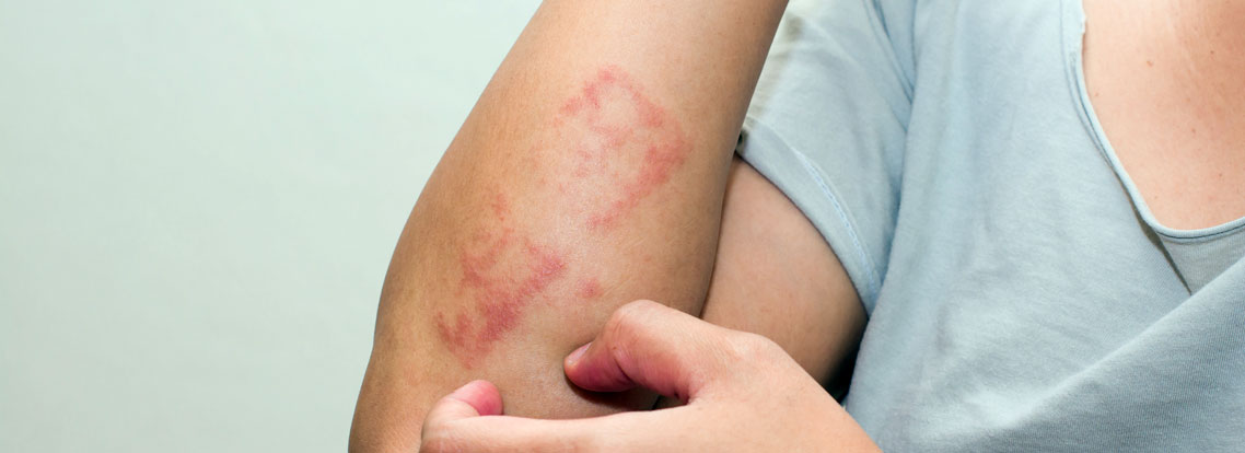 Eczema-dermatitis