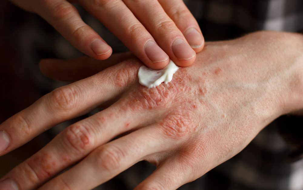 Most Common Skin Allergies